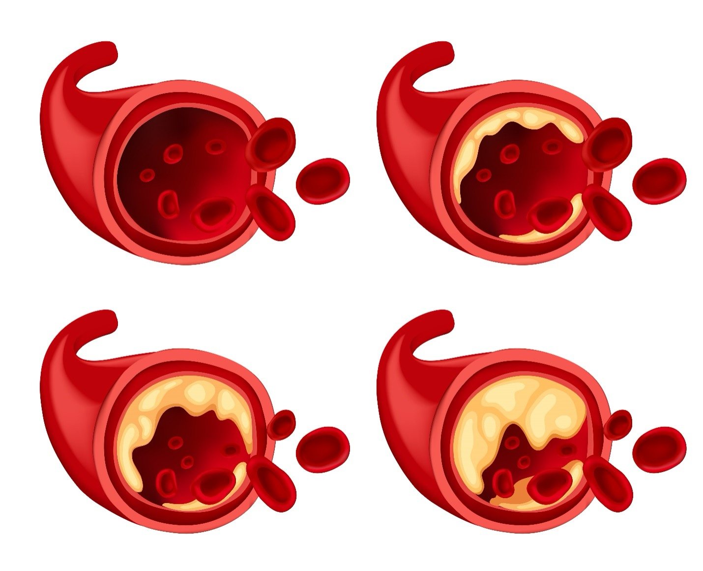 Peripheral Artery Disease