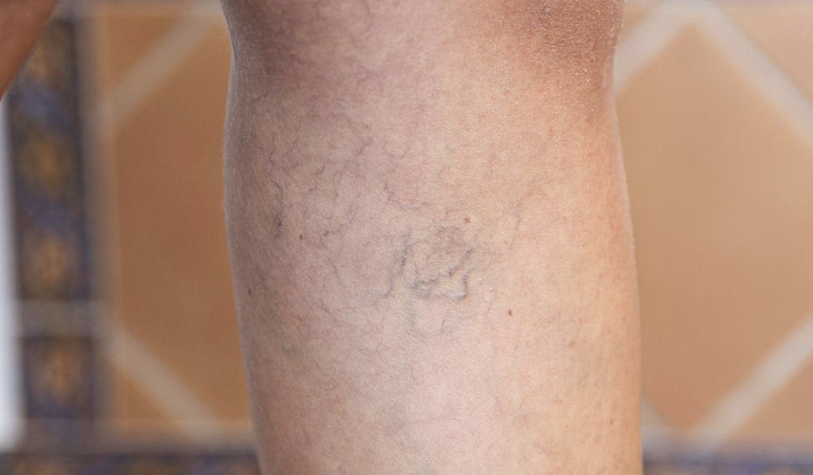 signs you need this test right away - venous insufficiency