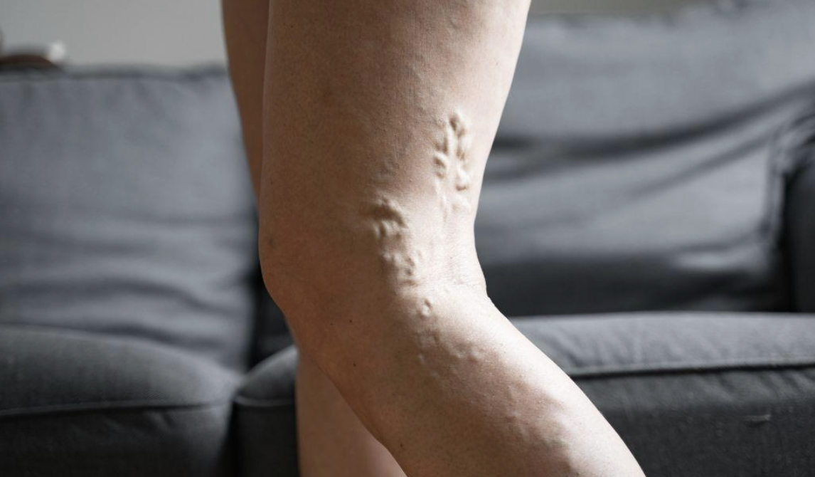 treatment options for deep vein thrombosis