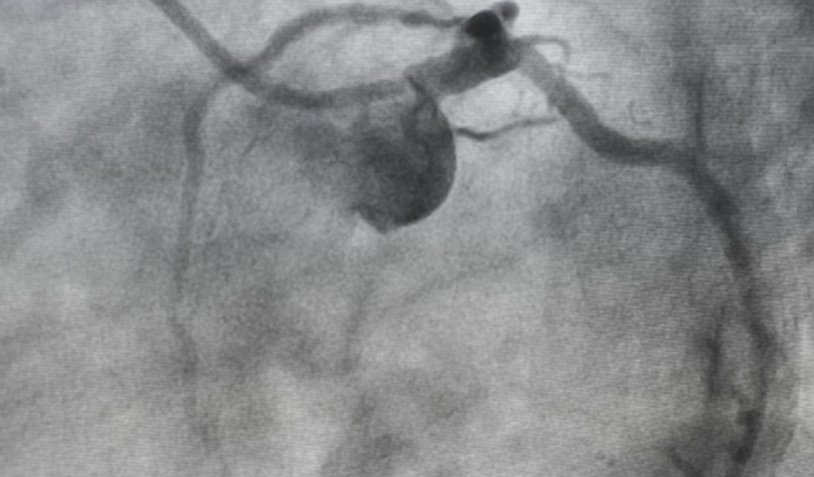 understanding coronary angiogram results in houston texas