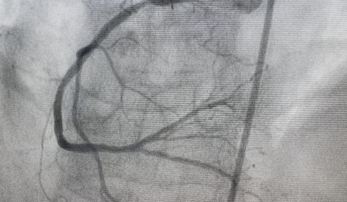 what is a coronary angiogram - modern heart and vascular