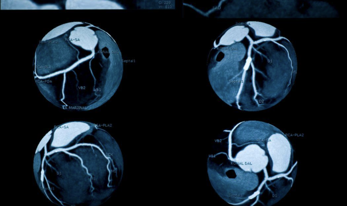 what is a coronary calcium score - modern heart and vascular