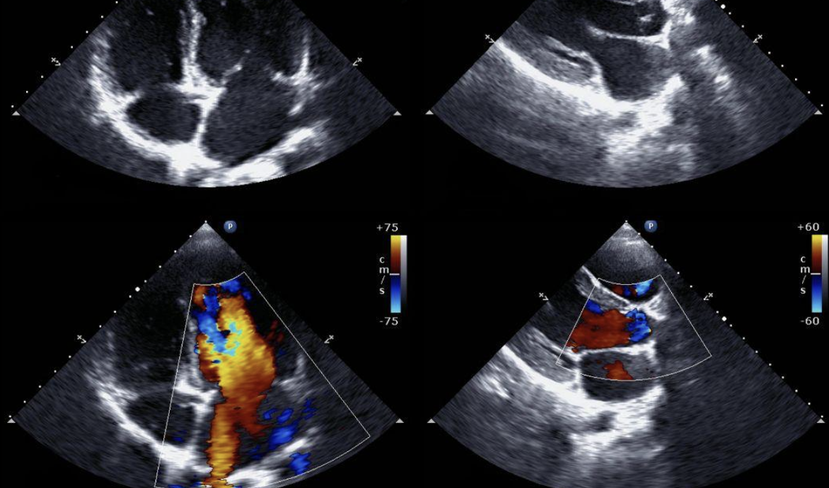 what is a pediatric echocardiogram - modern heart and vascular