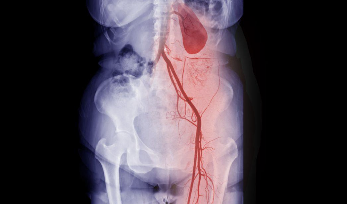 what is a peripheral angiogram - modern heart and vascular, cardiologist in houston, texas area