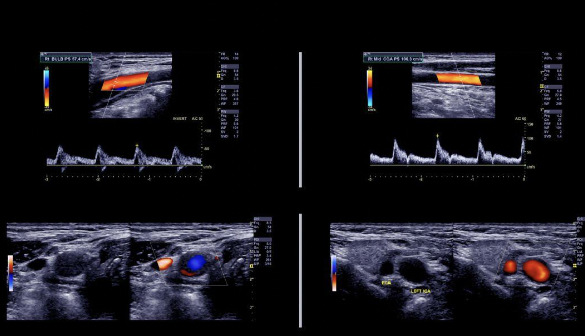 what is an arterial doppler ultrasound