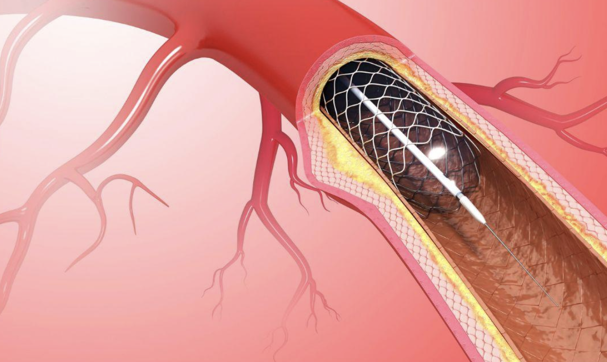 what is coronary stenting - modern heart and vascular