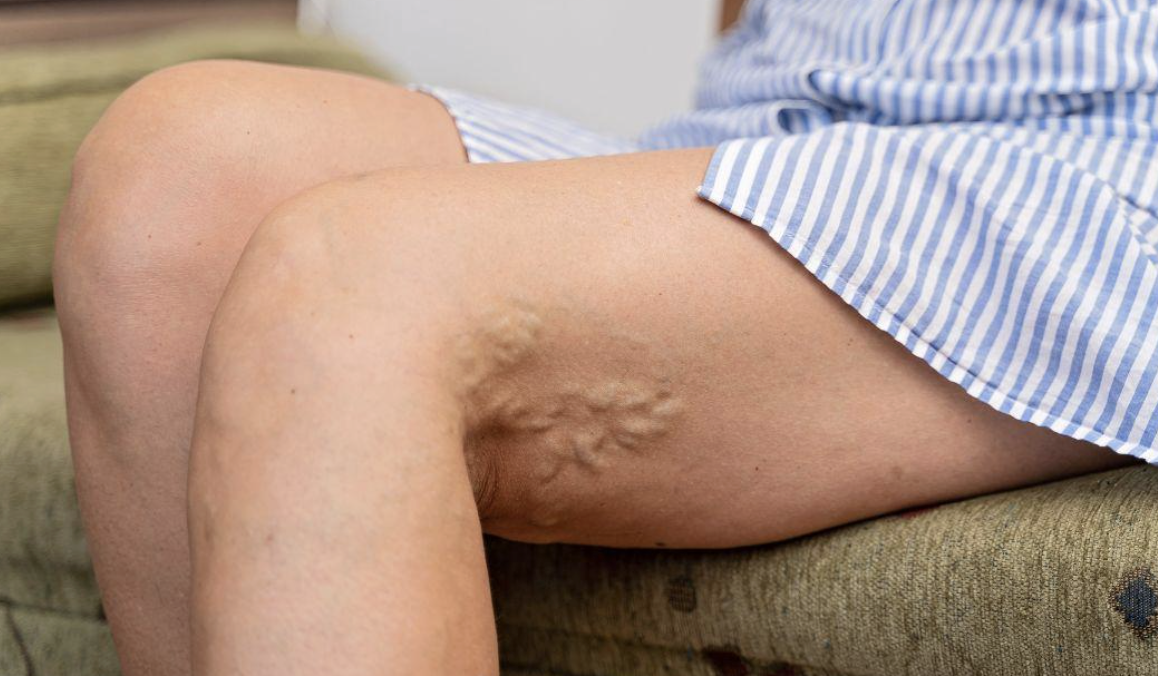 what is deep vein thrombosis (dvt) modern heart and vascular institute