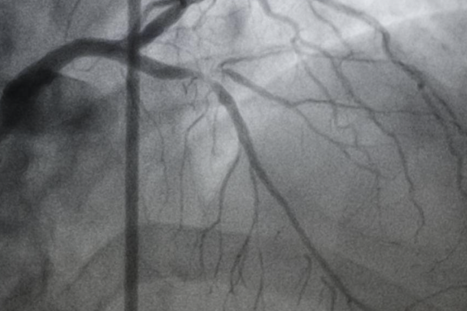 when should you get a coronary calcium score